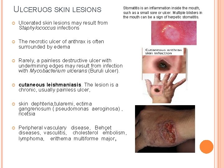 ULCERUOS SKIN LESIONS Stomatitis is an inflammation inside the mouth, such as a small