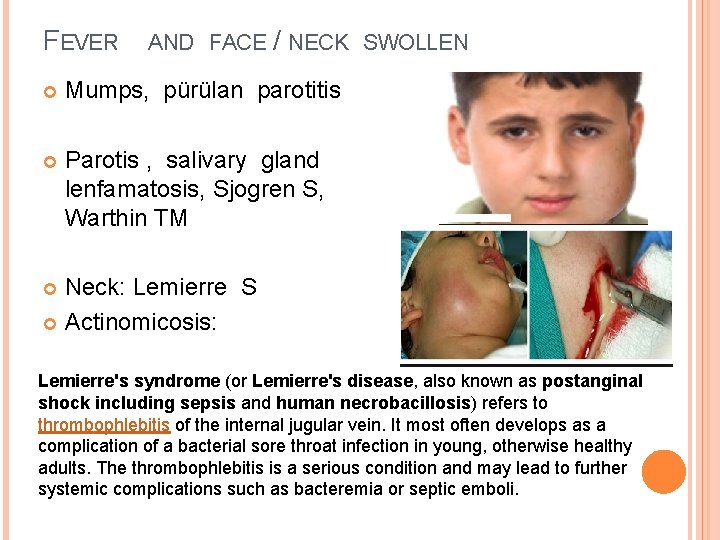 FEVER AND FACE / NECK SWOLLEN Mumps, pürülan parotitis Parotis , salivary gland lenfamatosis,
