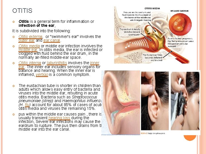 OTITIS Otitis is a general term for inflammation or infection of the ear, It