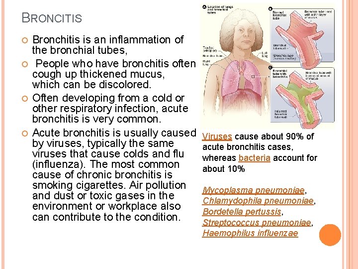 BRONCITIS Bronchitis is an inflammation of the bronchial tubes, People who have bronchitis often