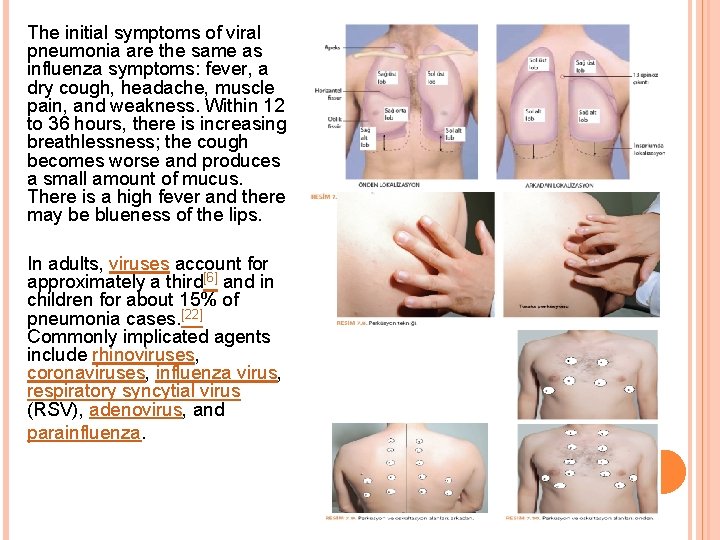 The initial symptoms of viral pneumonia are the same as influenza symptoms: fever, a