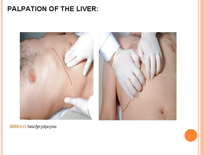 PALPATION OF THE LIVER: 