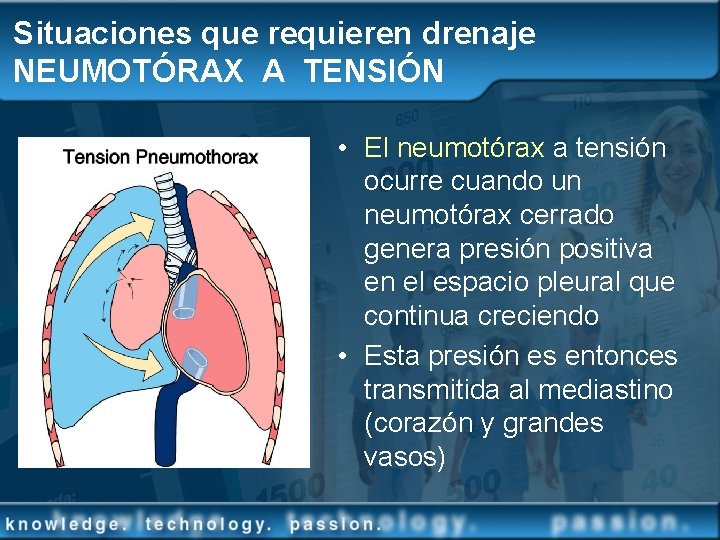 Situaciones que requieren drenaje NEUMOTÓRAX A TENSIÓN • El neumotórax a tensión ocurre cuando