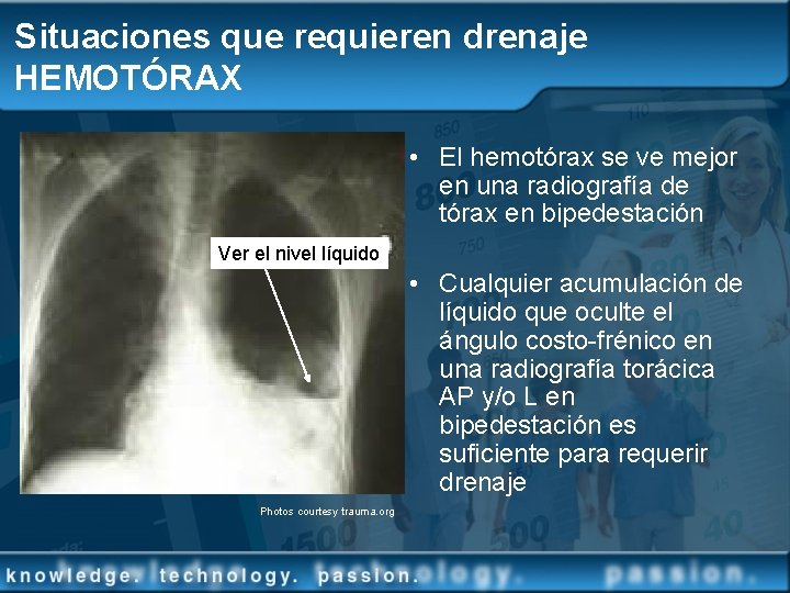 Situaciones que requieren drenaje HEMOTÓRAX • El hemotórax se ve mejor en una radiografía