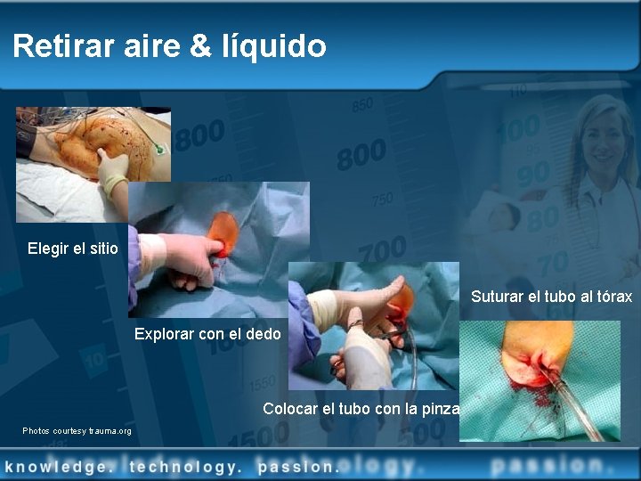 Retirar aire & líquido Elegir el sitio Suturar el tubo al tórax Explorar con