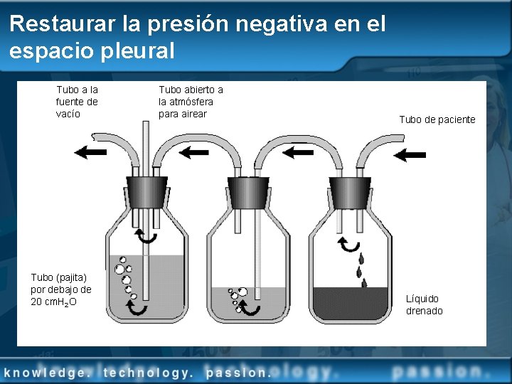 Restaurar la presión negativa en el espacio pleural Tubo a la fuente de vacío