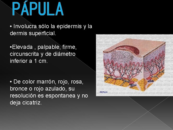 PÁPULA • Involucra sólo la epidermis y la dermis superficial. • Elevada , palpable,