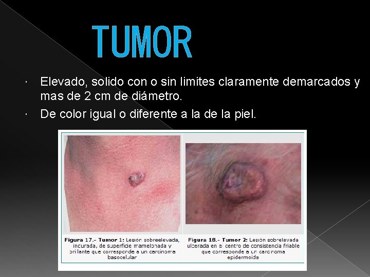 TUMOR Elevado, solido con o sin limites claramente demarcados y mas de 2 cm