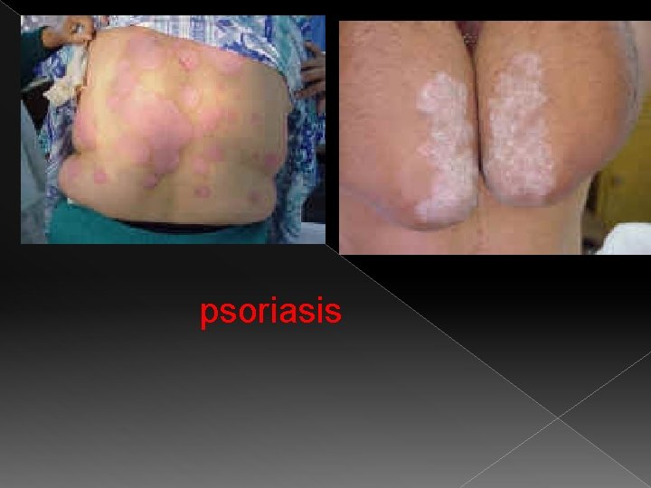 psoriasis 