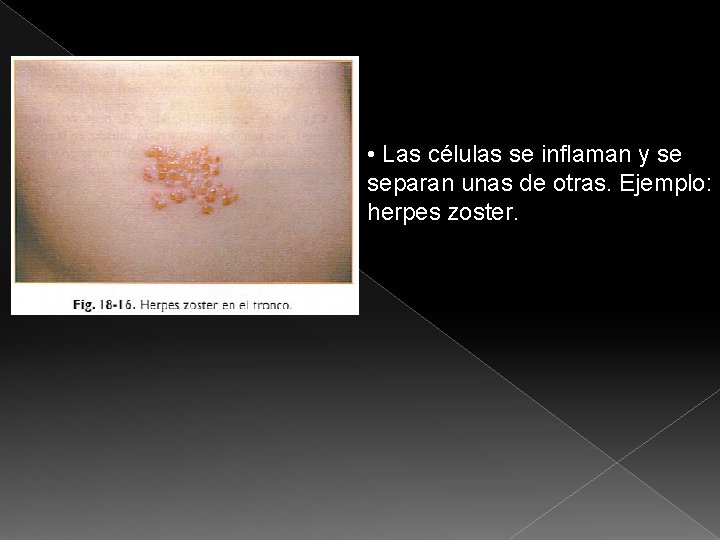  • Las células se inflaman y se separan unas de otras. Ejemplo: herpes