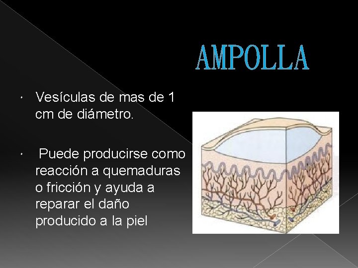 AMPOLLA Vesículas de mas de 1 cm de diámetro. Puede producirse como reacción a
