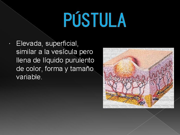 PÚSTULA Elevada, superficial, similar a la vesícula pero llena de líquido purulento de color,