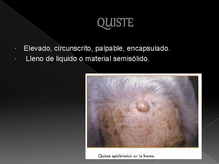 QUISTE Elevado, circunscrito, palpable, encapsulado. Lleno de liquido o material semisólido. 