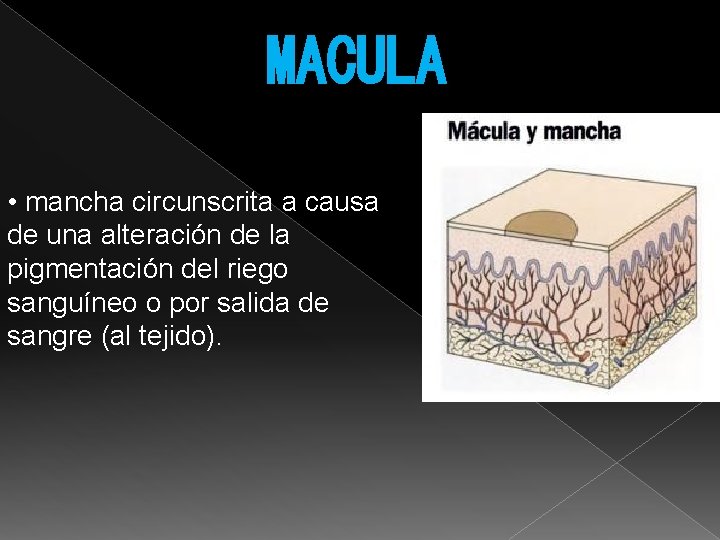 MACULA • mancha circunscrita a causa de una alteración de la pigmentación del riego