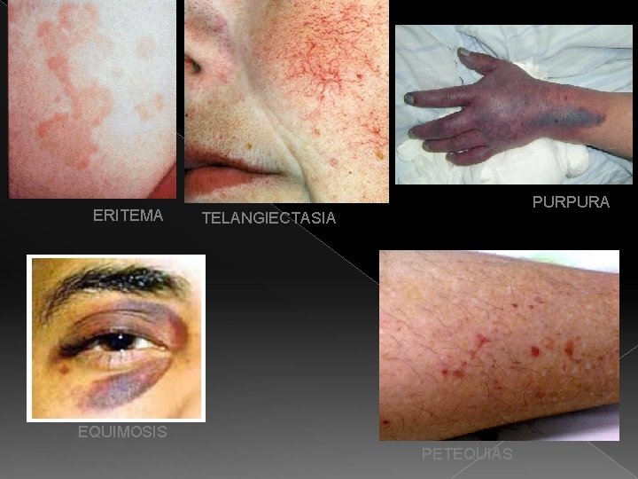 ERITEMA PURPURA TELANGIECTASIA EQUIMOSIS PETEQUIAS 