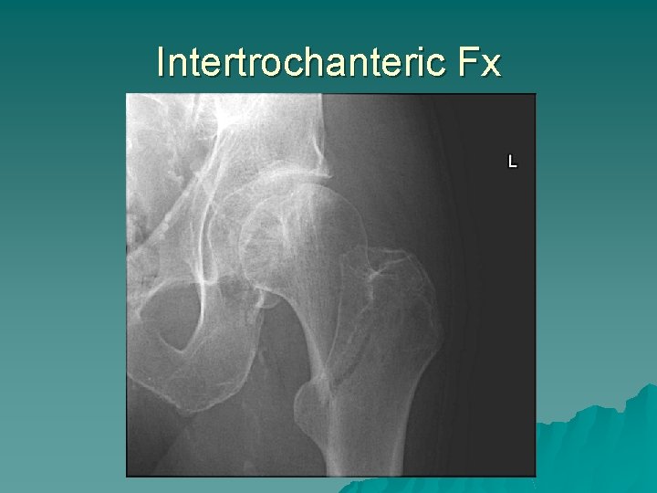 Intertrochanteric Fx 