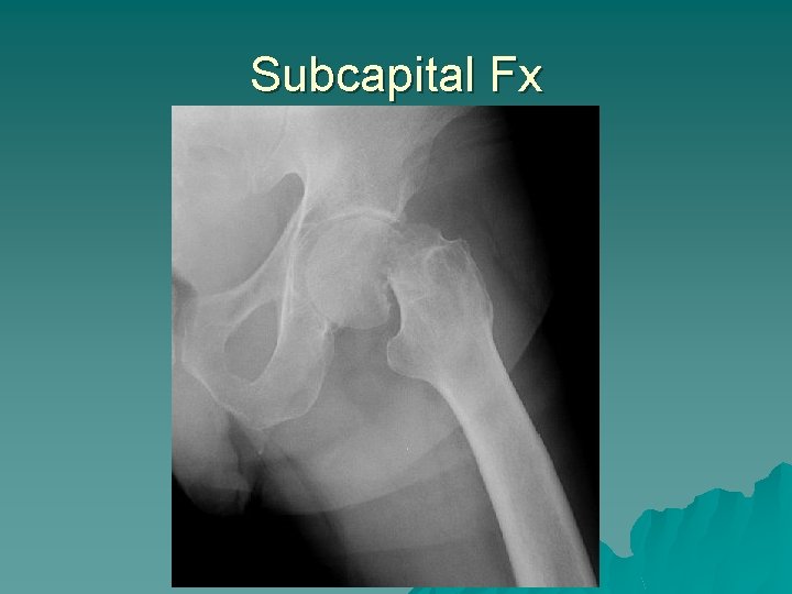 Subcapital Fx 