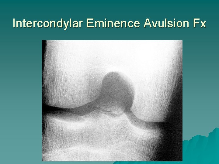 Intercondylar Eminence Avulsion Fx 