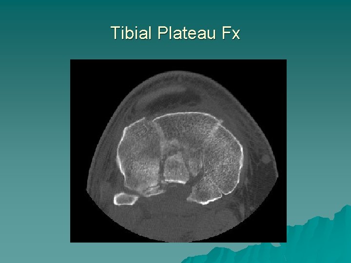 Tibial Plateau Fx 