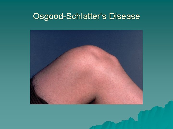 Osgood-Schlatter’s Disease 