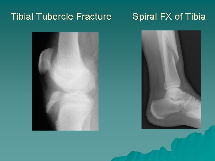 Tibial Tubercle Fracture Spiral FX of Tibia 