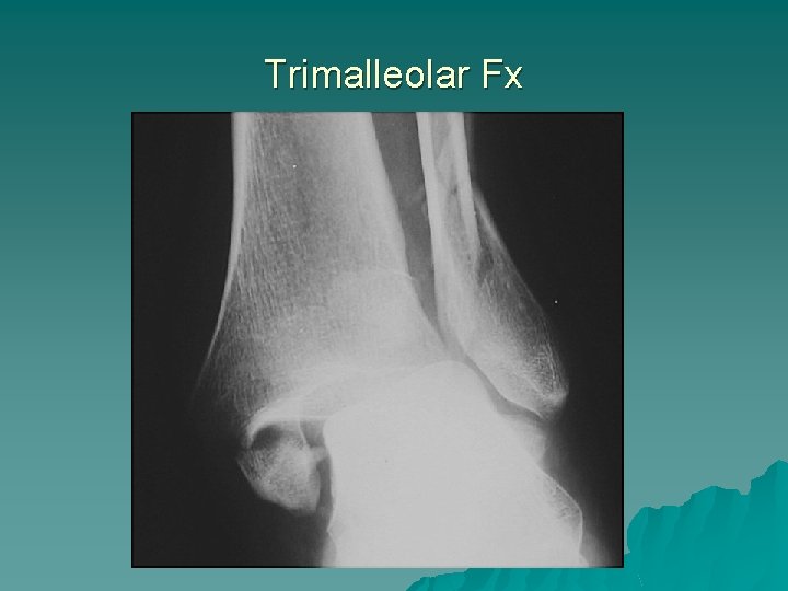 Trimalleolar Fx 