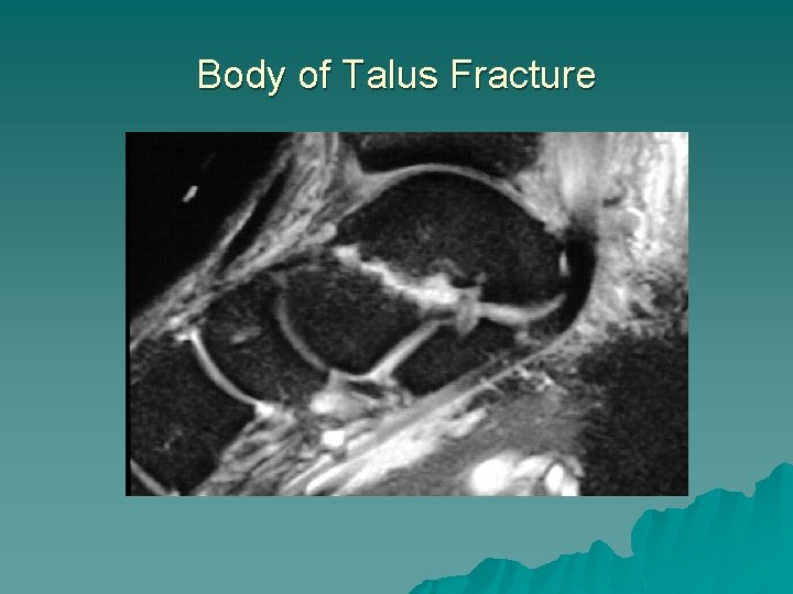 Body of Talus Fracture 