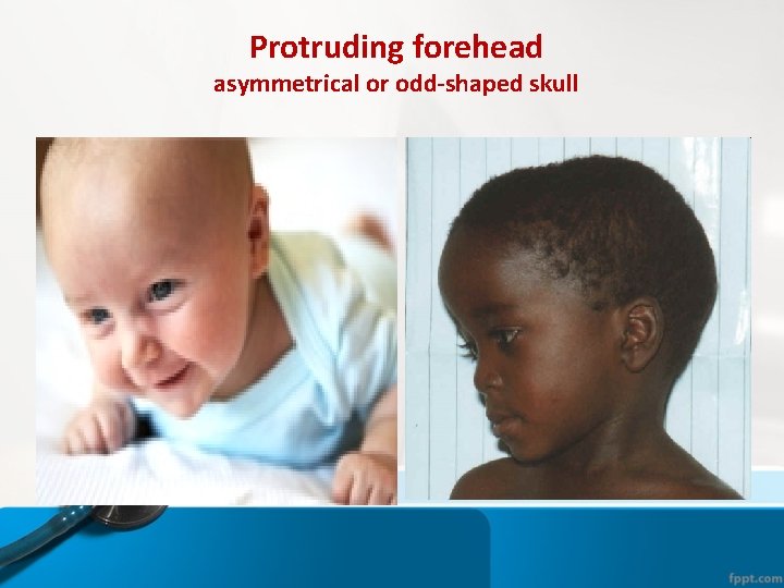 Protruding forehead asymmetrical or odd-shaped skull Protruding forehead asymmetrical or odd-shaped skull