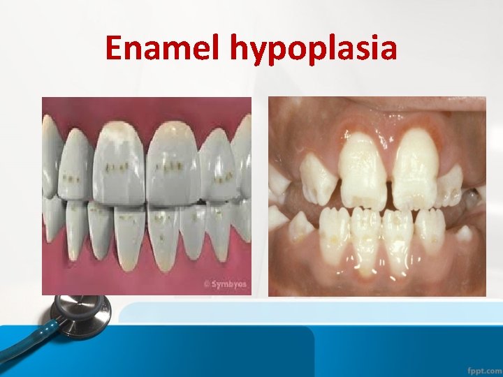Enamel hypoplasia Enamel hypoplasia
