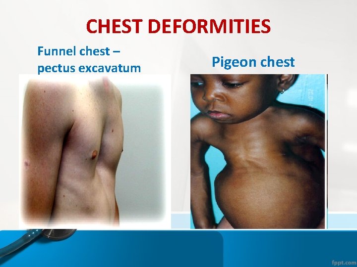 CHEST DEFORMITIES Funnel chest – pectus excavatum Pigeon chest CHEST DEFORMITIES Funnel chest – pectus excavatum Pigeon chest