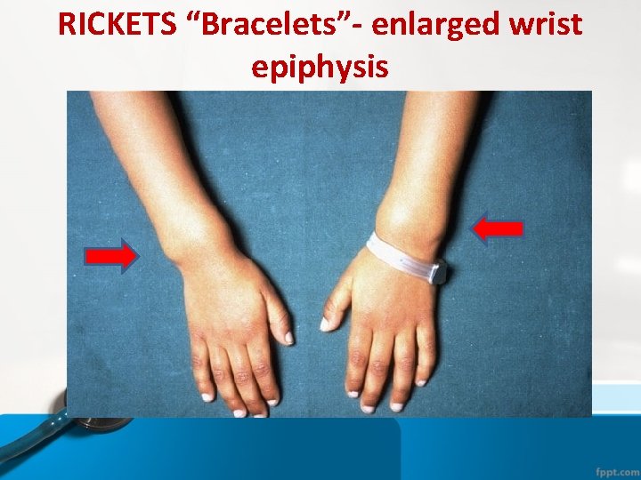 RICKETS “Bracelets”- enlarged wrist epiphysis RICKETS “Bracelets”- enlarged wrist epiphysis