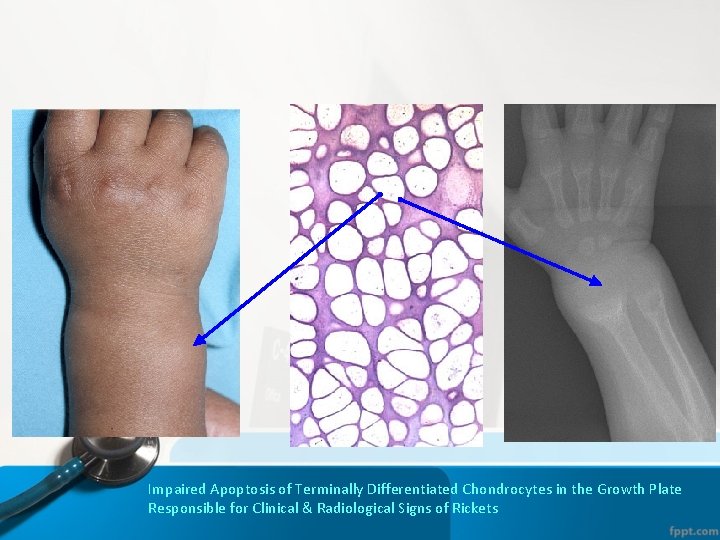 Impaired Apoptosis of Terminally Differentiated Chondrocytes in the Growth Plate Responsible for Clinical & Impaired Apoptosis of Terminally Differentiated Chondrocytes in the Growth Plate Responsible for Clinical &