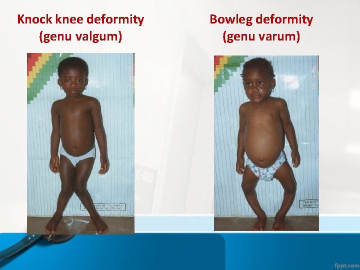 Knock knee deformity (genu valgum) Bowleg deformity (genu varum) Knock knee deformity (genu valgum) Bowleg deformity (genu varum)