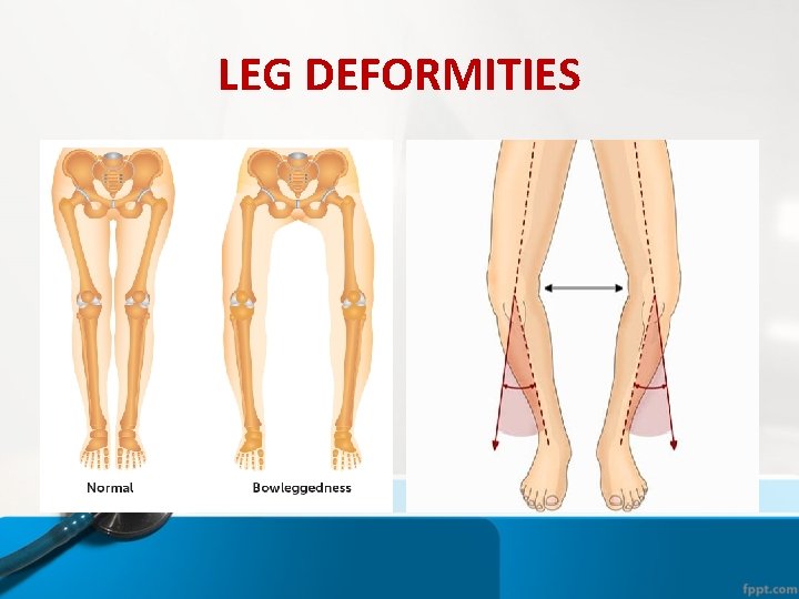 LEG DEFORMITIES LEG DEFORMITIES