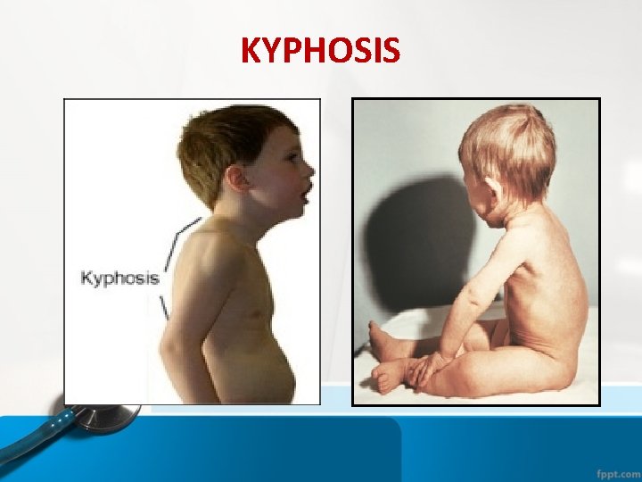 KYPHOSIS KYPHOSIS