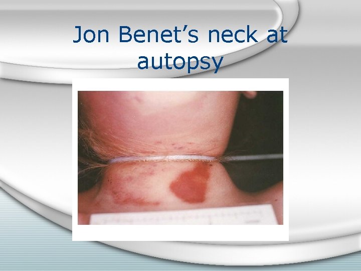 Jon Benet’s neck at autopsy 