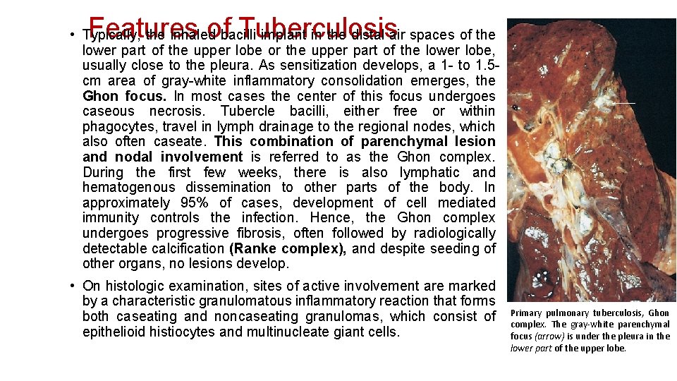 Features of Tuberculosis • Typically, the inhaled bacilli implant in the distal air spaces