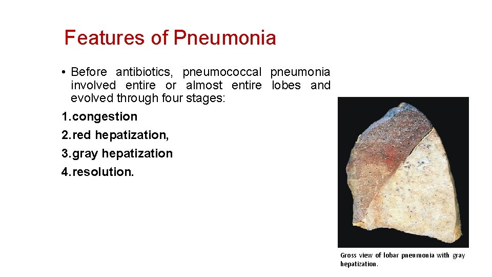 Features of Pneumonia • Before antibiotics, pneumococcal pneumonia involved entire or almost entire lobes