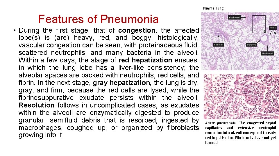 Normal lung Features of Pneumonia • During the first stage, that of congestion, the