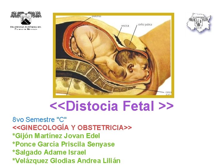 <<Distocia Fetal >> 8 vo Semestre "C" <<GINECOLOGÍA Y OBSTETRICIA>> *Gijón Martínez Jovan Edel <<Distocia Fetal >> 8 vo Semestre "C" <<GINECOLOGÍA Y OBSTETRICIA>> *Gijón Martínez Jovan Edel