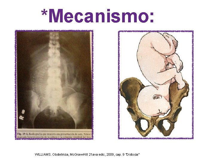 *Mecanismo: WILLIAMS. Obstetricia, Mc. Graw-Hill 21 ava edic, 2009, cap. 9 "Distocia" *Mecanismo: WILLIAMS. Obstetricia, Mc. Graw-Hill 21 ava edic, 2009, cap. 9 "Distocia"