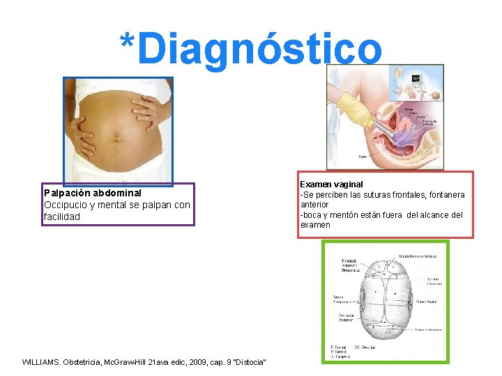 *Diagnóstico Palpación abdominal Occipucio y mental se palpan con facilidad WILLIAMS. Obstetricia, Mc. Graw-Hill *Diagnóstico Palpación abdominal Occipucio y mental se palpan con facilidad WILLIAMS. Obstetricia, Mc. Graw-Hill