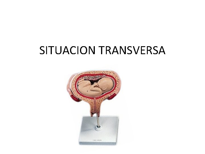 SITUACION TRANSVERSA SITUACION TRANSVERSA