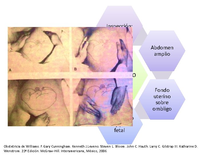 Inspección: Dorso anterior o posterior Abdomen amplio DIAGNOSTICO Fondo uterino sobre ombligo Peloteo en Inspección: Dorso anterior o posterior Abdomen amplio DIAGNOSTICO Fondo uterino sobre ombligo Peloteo en