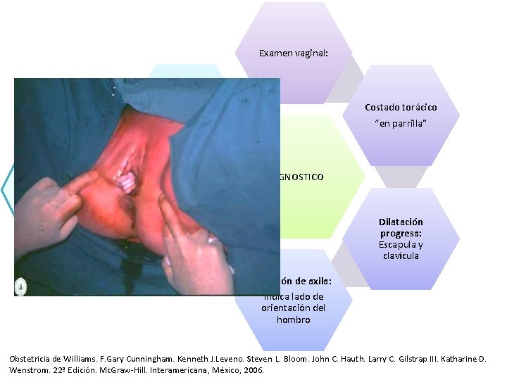 Examen vaginal: Mano o brazo prolapsan por vagina o vulva Costado torácico “en parrilla” Examen vaginal: Mano o brazo prolapsan por vagina o vulva Costado torácico “en parrilla”