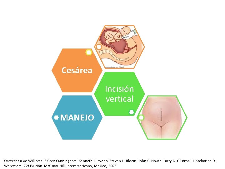 Cesárea Incisión vertical MANEJO Obstetricia de Williams. F. Gary Cunningham. Kenneth J. Leveno. Steven Cesárea Incisión vertical MANEJO Obstetricia de Williams. F. Gary Cunningham. Kenneth J. Leveno. Steven