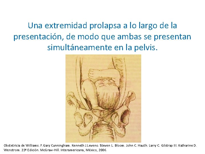 Una extremidad prolapsa a lo largo de la presentación, de modo que ambas se Una extremidad prolapsa a lo largo de la presentación, de modo que ambas se