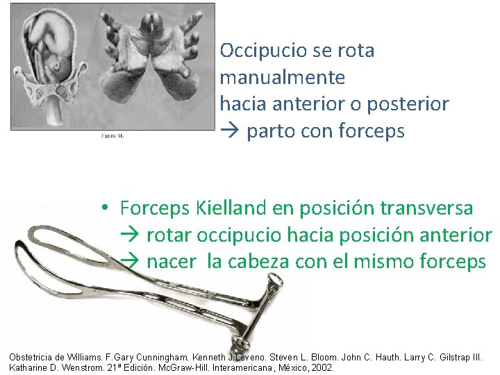 Occipucio se rota manualmente hacia anterior o posterior parto con forceps • Forceps Kielland Occipucio se rota manualmente hacia anterior o posterior parto con forceps • Forceps Kielland