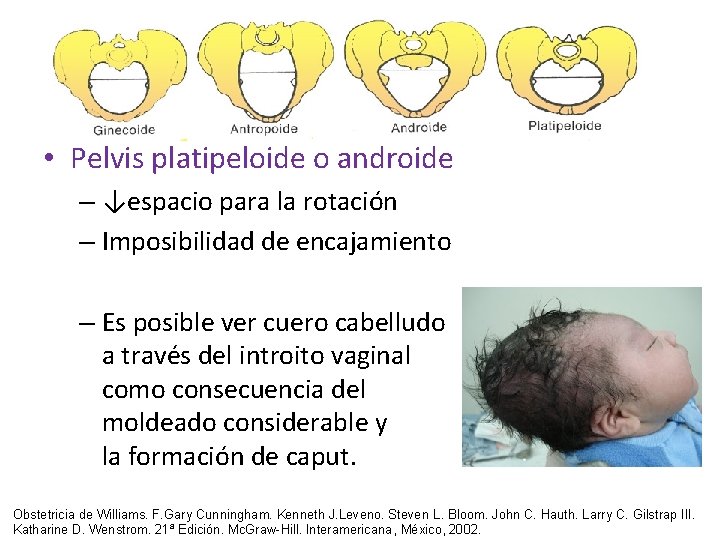 • Pelvis platipeloide o androide – ↓espacio para la rotación – Imposibilidad de • Pelvis platipeloide o androide – ↓espacio para la rotación – Imposibilidad de