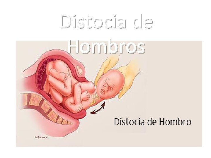 Distocia de Hombros Distocia de Hombros
